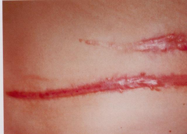 hypertrophic_scar015.jpg