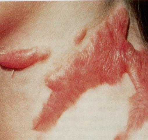 keloid016.jpg