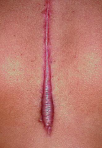 keloid_scar_01_HIGHRES.jpg